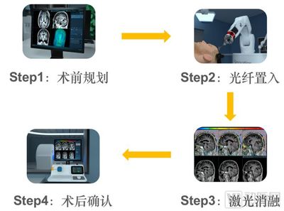 医学突破 国内首创华科精准磁共振引导激光消融系统获批上市